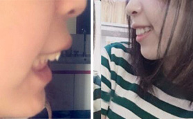 深覆合矯正案例：在深圳爾睦口腔做正雅隱形矯正2年變化