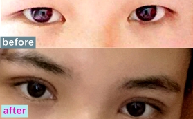 我找山東青島諾美德醫(yī)院姜留剛做切開雙眼皮1個(gè)月后悔了