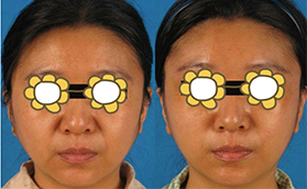 畢洪森內(nèi)窺鏡除皺多少錢(qián)？奉上北醫(yī)三院除皺案例及價(jià)格表