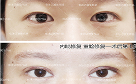 北京張冰潔修復(fù)雙眼皮怎么樣？案例及價格表看技術(shù)亮點