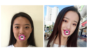 昆明華美美萊李韜技術(shù)如何？分享急速納米雙眼皮案例參考