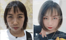 同樣是雙眼皮，怪不得找昆明美伊萊周誠(chéng)做的評(píng)價(jià)很高