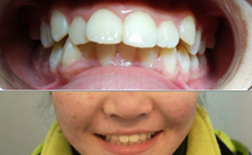 我在青島全好口腔做牙齒矯正真實(shí)感受，附前后對(duì)比照片