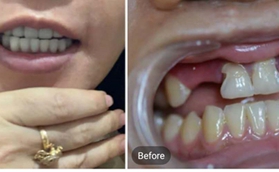 真實案例告訴你，為什么選擇在南京金鉑利做種植牙