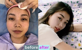 做了超皮秒會(huì)反黑?沈陽伊美爾面部祛斑治療案例告訴你原因