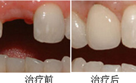 我是在北京維樂口腔中關(guān)村店做了單顆韓國奧齒泰種植牙