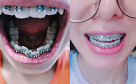 輕度牙齒擁擠下門牙內(nèi)向擠歪,戴奧美科金屬托槽矯正后效果