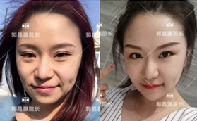 北京郭昌灝AAT全面部脂肪填充術(shù)案例:親測(cè)醫(yī)生技術(shù)感覺蠻好