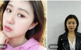 南京韓辰醫(yī)院做玻尿酸隆鼻后悔死了，前后對比圖來看效果