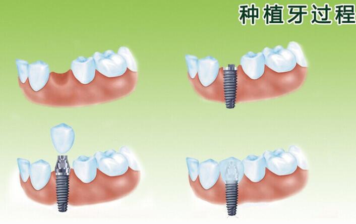 洛陽友好口腔種植效果怎么樣？價格貴不？有終身質(zhì)保嗎？