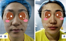 倆姐妹用五代熱瑪吉的900發(fā)探頭做完全臉后都說沒那么疼