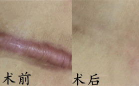 長沙卓而美醫(yī)療美容醫(yī)院疤痕修復(fù)對(duì)比案例
