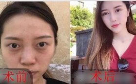 做鼻綜合有沒有后遺癥？看我在南京瑧顏?zhàn)龅男Ч趺礃?></div>
                      </a>
                    </li>
                                                          </ul>
                </td>
            </tr>
          </tbody>
        </table>
      </div>
      <div   id=