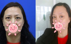 外切去眼袋后的疤痕無法愈合?并不會，這有真人案例參考哦