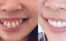 牙齒矯正會(huì)改變臉型嗎？我在南京牙院長做完很滿意