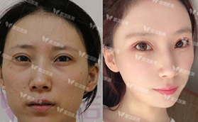 北京紫潔祛眼袋多少錢?找王春燕做UM無痕不開刀去眼袋花2w多