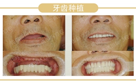 沈陽(yáng)完佩口腔61歲大爺做完全口種植牙后的真實(shí)感受分享