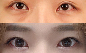 韓國TS整形外科的眼修復(fù)怎么樣?李相均雙眼皮整形特點(diǎn)如下