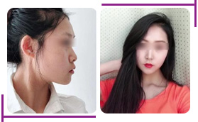 濟南美蓮醫(yī)療美容醫(yī)院膨體隆鼻對比