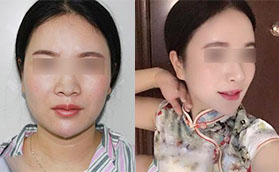 合肥臺美麗格埋線隆鼻