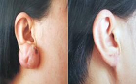 濟(jì)南蔡景龍醫(yī)療美容耳后瘢痕疙瘩切除+SRT放射治療