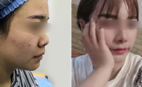 濟(jì)南鵬愛鼻部多項-耳軟骨隆鼻對比