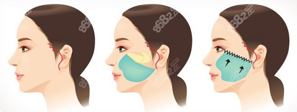 筋膜懸吊面部提升能維持多久